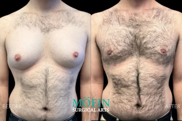 Gynecomastia surgery before and after Los Angeles — patient 1