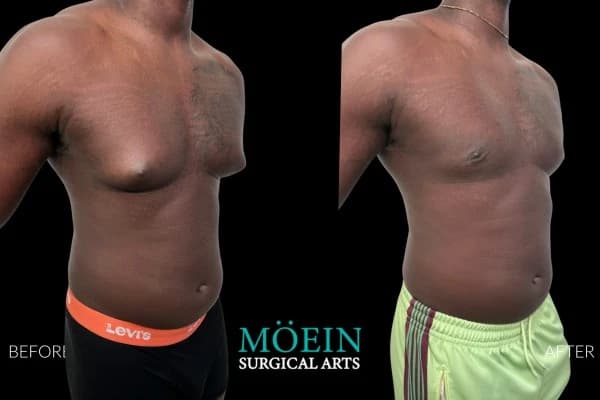 Gynecomastia surgery before and after Los Angeles — patient 2