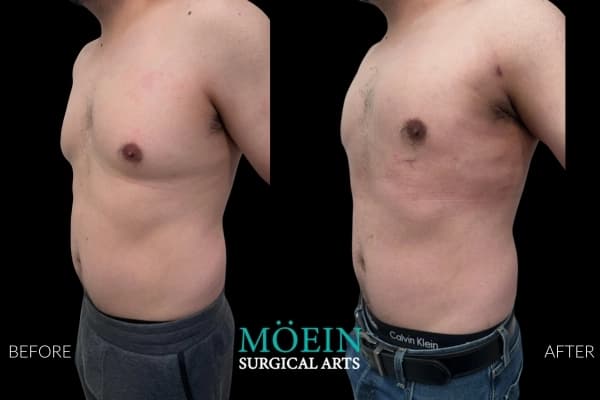 Gynecomastia surgery before and after Los Angeles — patient 8