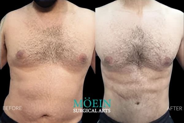 Abdominal etching six-pack surgery before and after Los Angeles