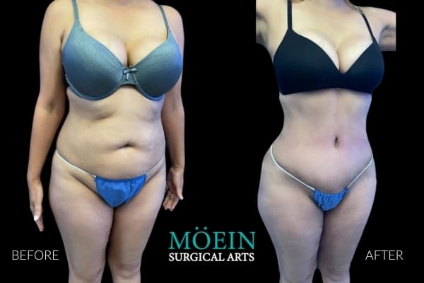 VASER liposuction before and after Los Angeles — patient 1