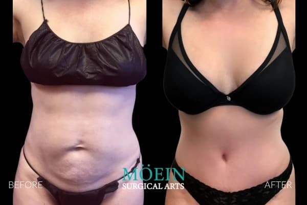 VASER liposuction before and after Los Angeles — patient 5