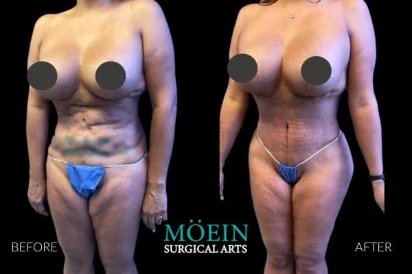VASER liposuction before and after Los Angeles — patient 6