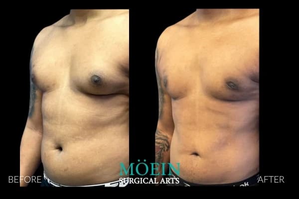 VASER liposuction before and after Los Angeles — patient 7