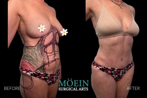 VASER liposuction before and after Los Angeles — patient 9